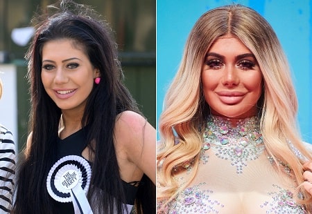 A picture of Chloe Ferry before (left) and after (right)  plastic surgeries.